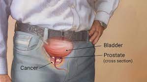 prostate treatment